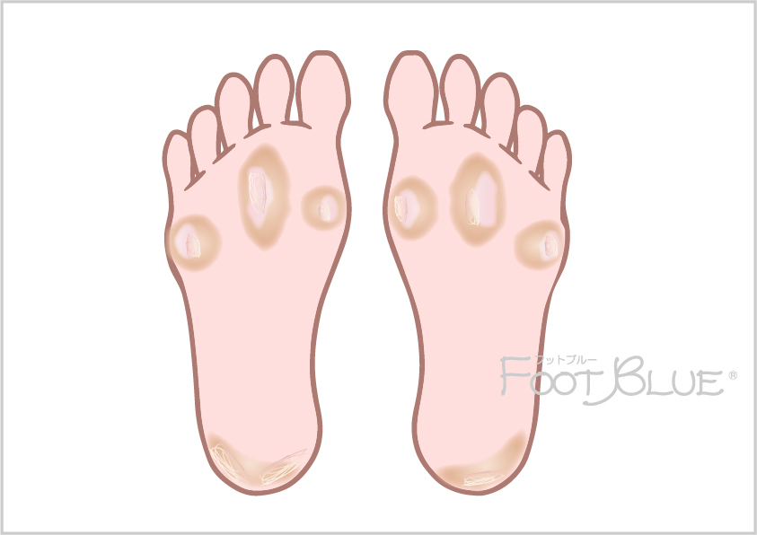 キャンペーン情報 | ドイツ式フットケアサロン フットブルー | お腹ポッコリ、パンパンの太ももはそのタコのせいかも⁉