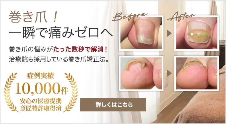 巻き爪！一瞬で痛みゼロへ