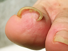 歩行時に巻き爪の痛みがあった40代女性のお客様の施術前の状態（指先側から撮影）フットブルー 症例06