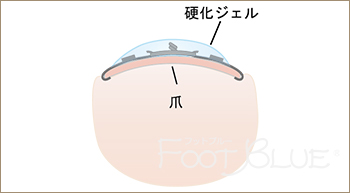 インベントプラスによる巻き爪矯正の施術工程step3