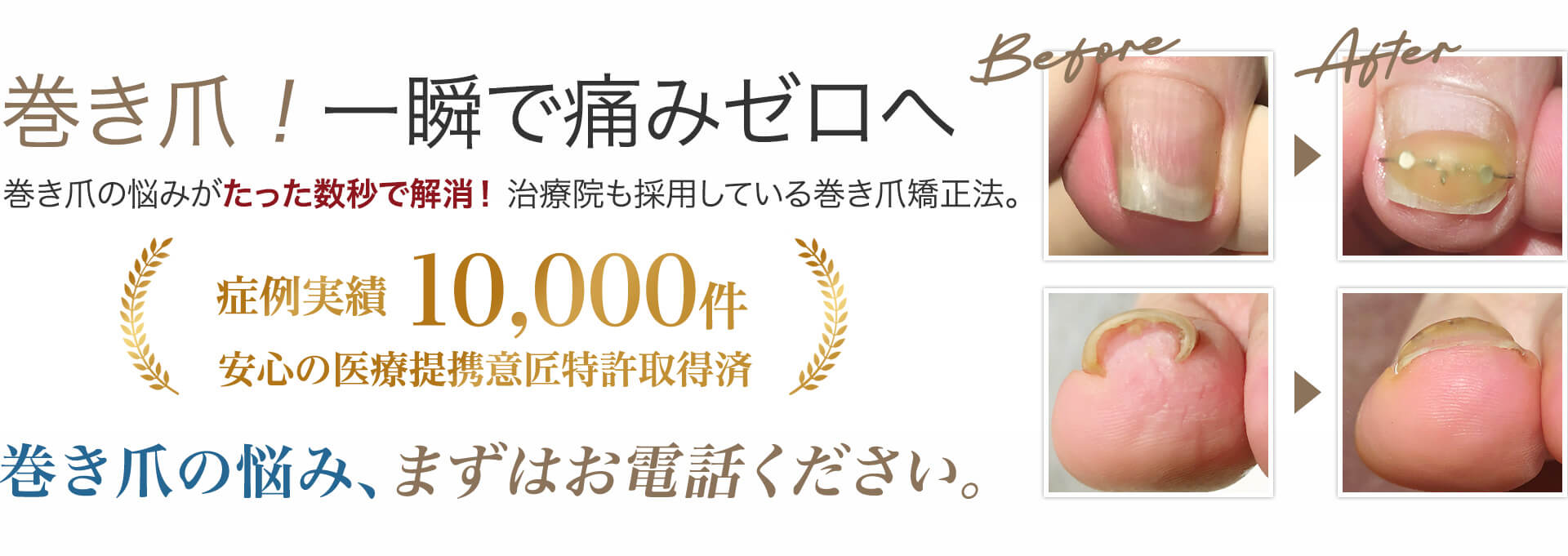 巻き爪!一瞬で痛みゼロへ。巻き爪の悩み、まずはお電話ください。