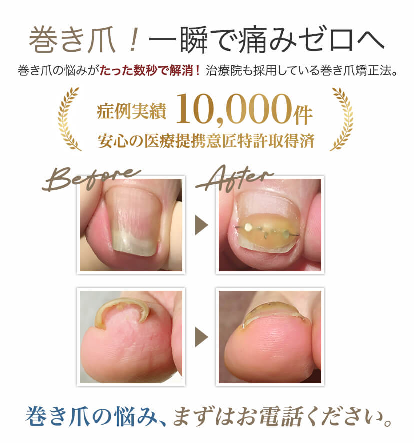 巻き爪！一瞬で痛みゼロへ。巻き爪の悩み、まずはお電話ください。